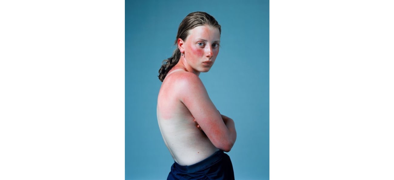 Hendrik Kerstens, Sunburnt, 2001, color print 150x120 cm Courtesy of the artist and Artspace Witzenhausen, Amsterdam