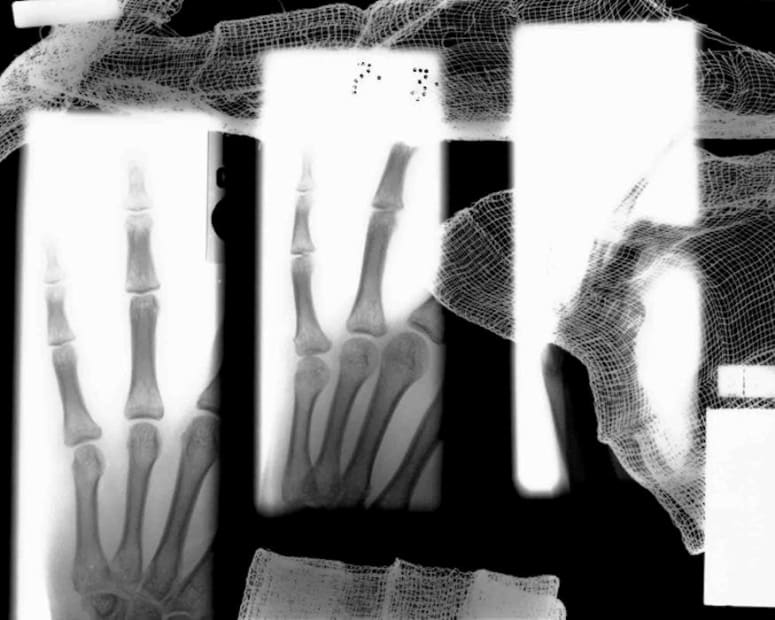 Broken Finger, 2007