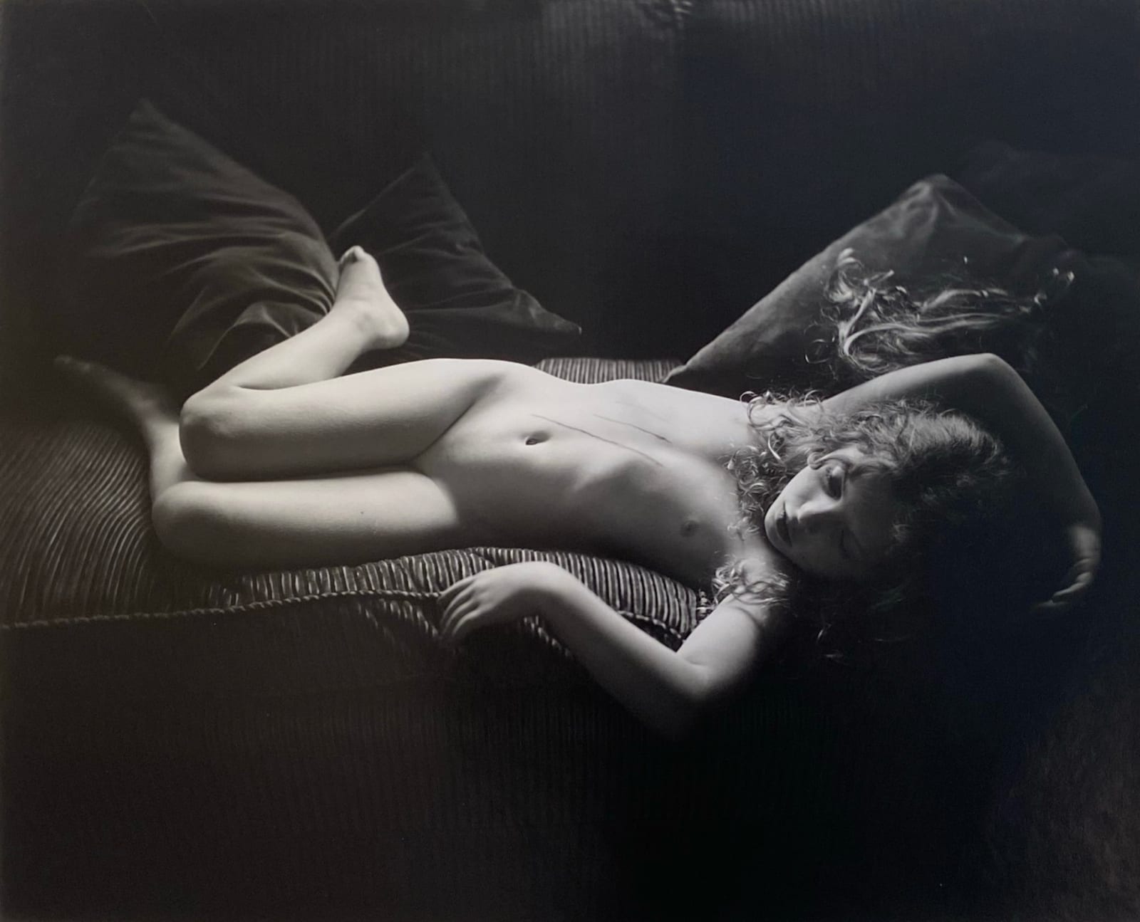 Virginia lying on couch with dog scratches on torso, from the Immediate Family series, by Sally Mann