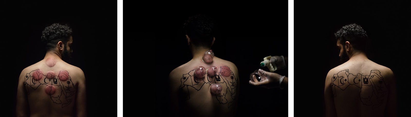 Abdulnasser Gharem, Hijamah (Traditional Pain Treatment Performance), 2015