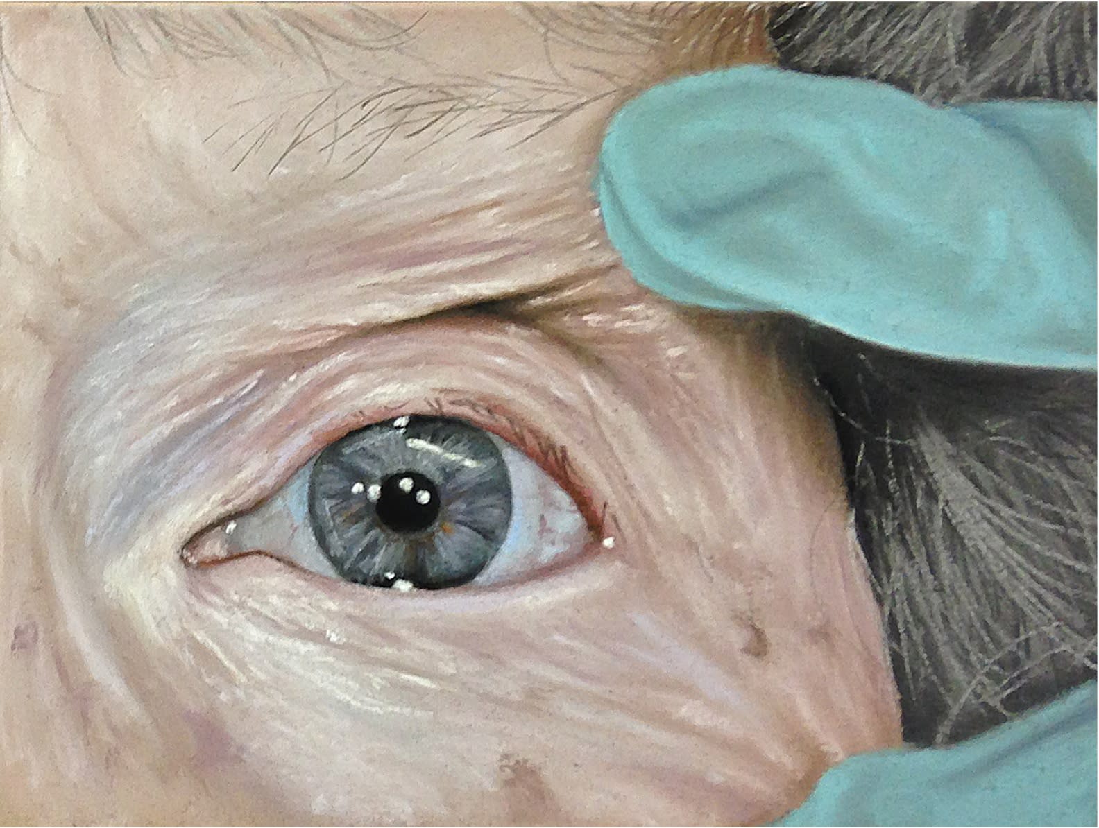 Oliver Jones Reduces The Signs of Wrinkles (Left Eye), 2014