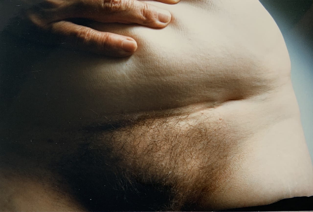 Jo Spence, Photo therapy: Tracing her Story in Scars, 1985