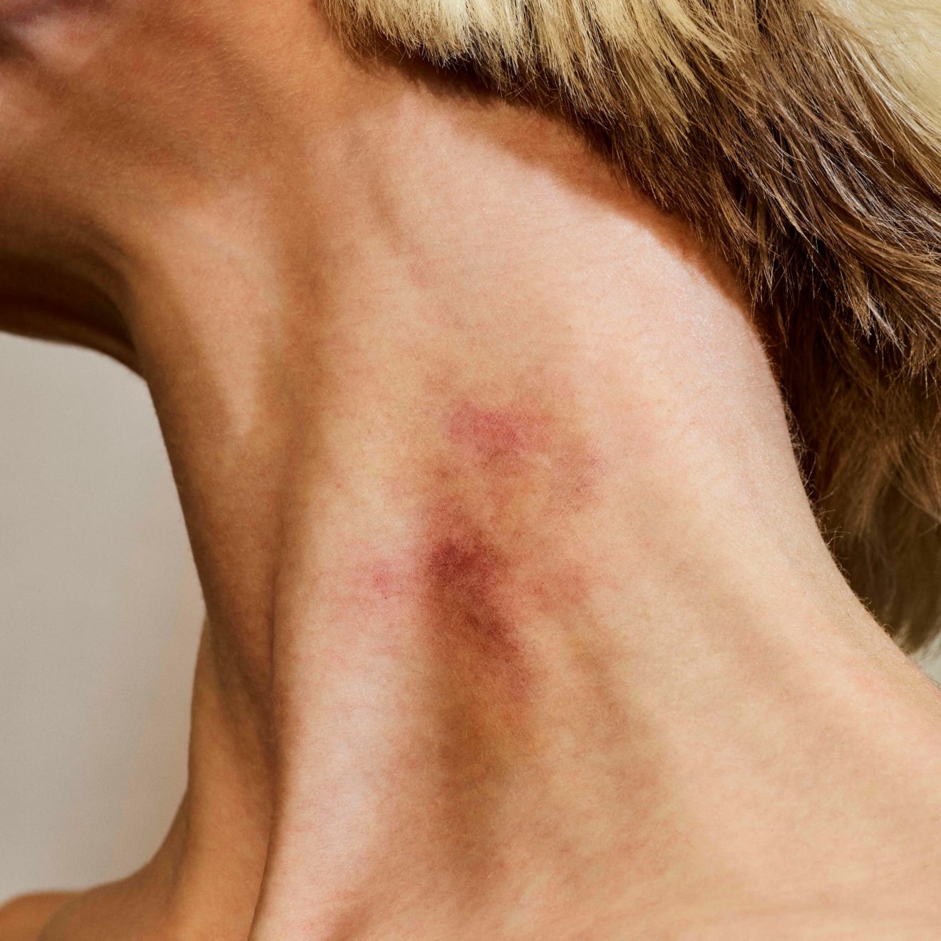 Casper Sejersen, Love Bite , 2019