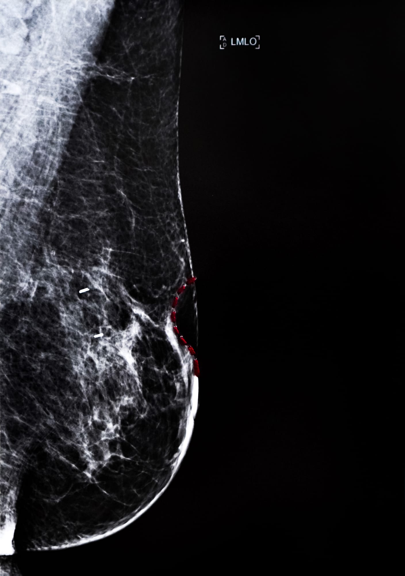 Sunaina Bhalla, Mammogram Series, Incursions, Incisions and Transgressions #Lv, 2020