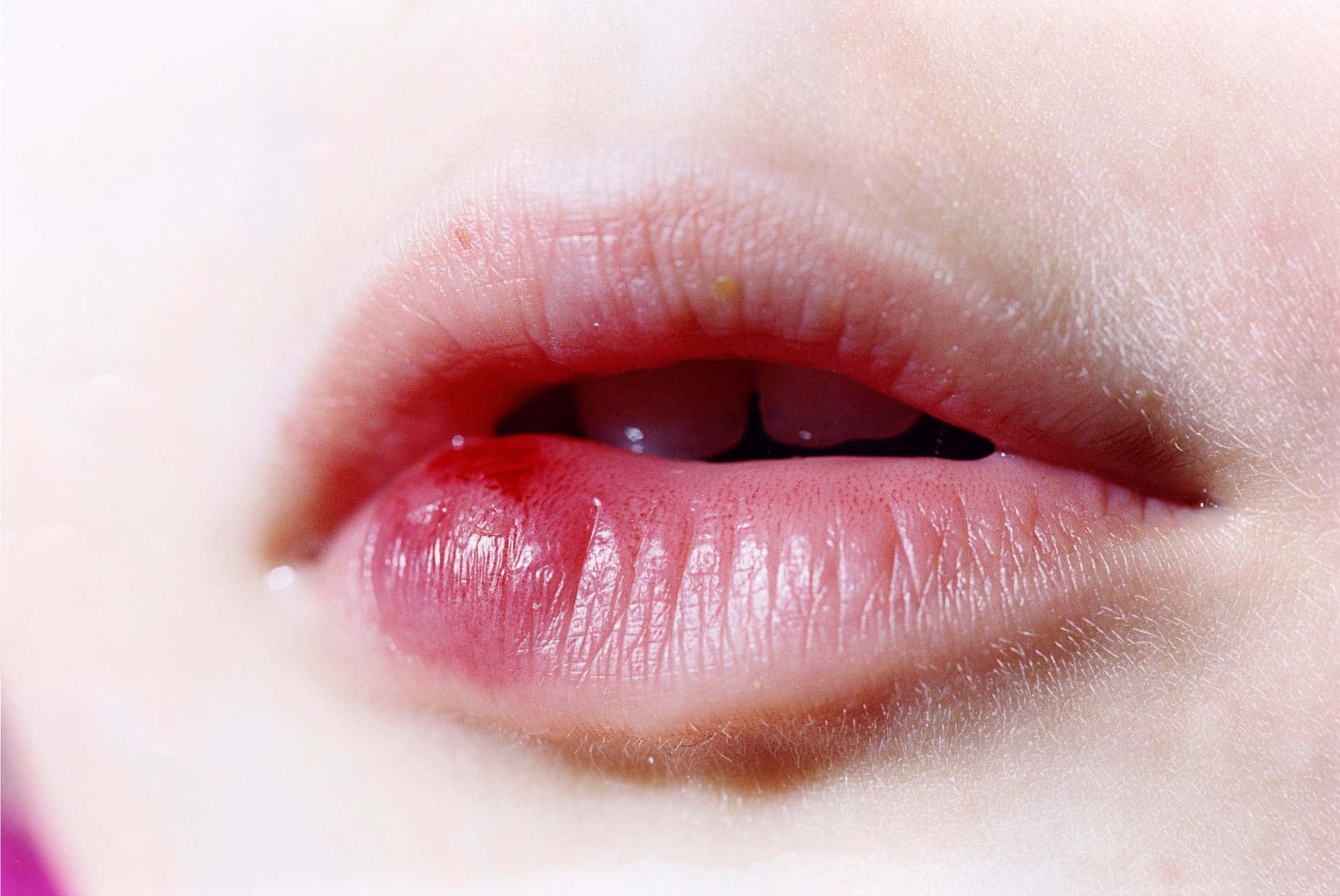 Elinor Carucci, Bruised mouth, 2007