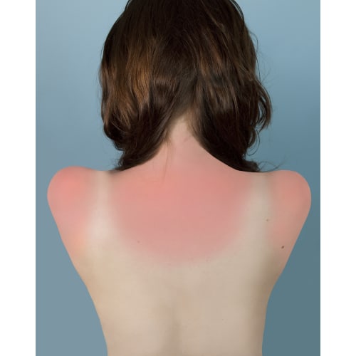 Brea Souders, Sunburn in Naples, 2010