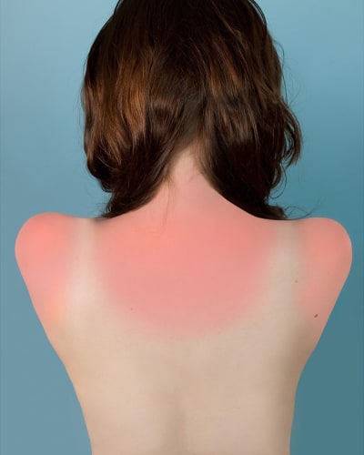 Brea Souders, Sunburn in Naples, 2010