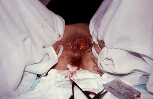 Regina José Galindo, Himenoplastia, 2004