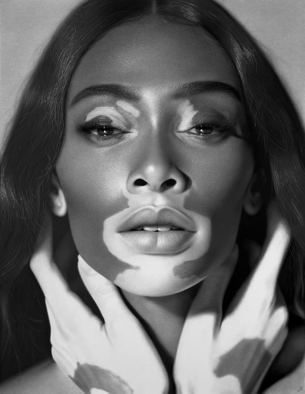 Kelvin Okafor, Winnie Harlow / Vitiligo, 2024