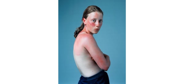 Hendrik Kerstens, Sunburnt, 2001, color print 150x120 cm Courtesy of the artist and Artspace Witzenhausen, Amsterdam