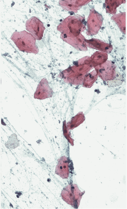 Matthieu Graffensttaden, Oeuvre 3 Tirage Fine Art Encadrement Plexiglas Cytologie Coloration Papanicolaou