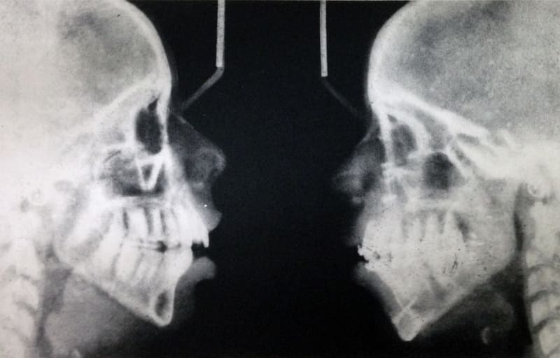 Alana Francis Self Portrait (my two skulls), 2015